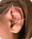 Ear Acupuncture